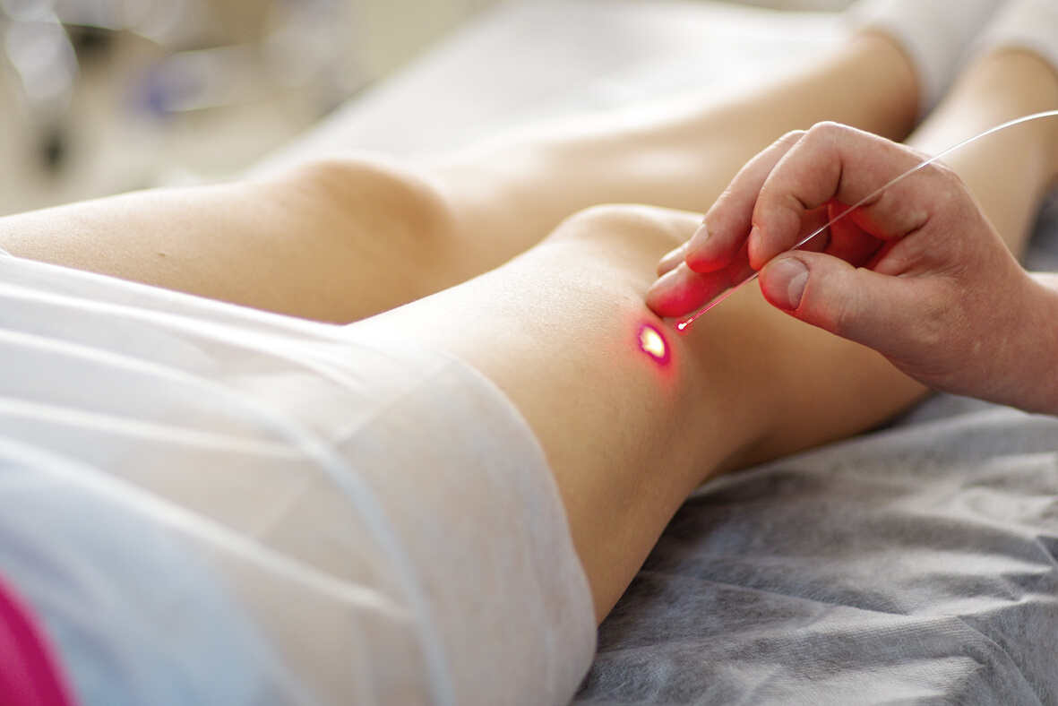 Varicose laser treatment